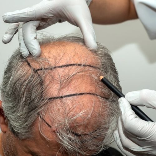 Hair Transplant