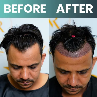 No Shave Hair Transplant